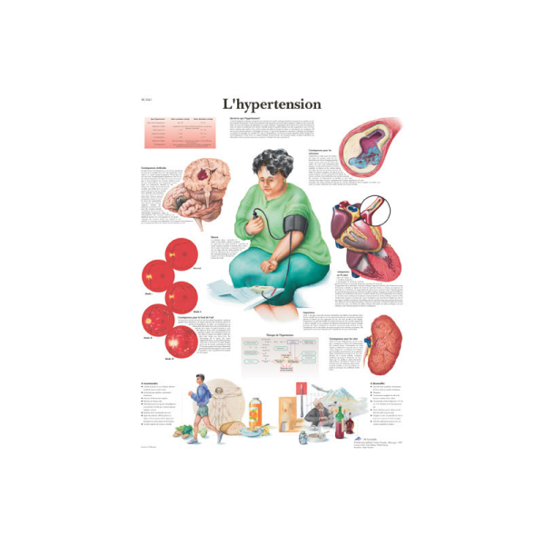 Planche anatomique sur l’hypertension 3bs Scientific